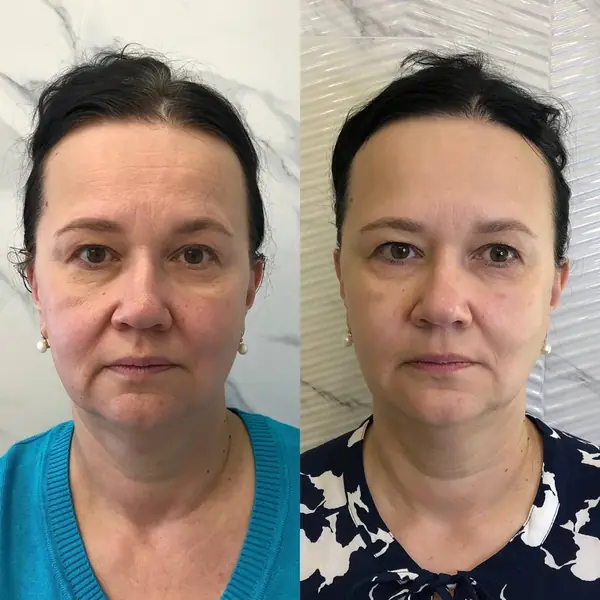 Before and after — reduced facial puffiness