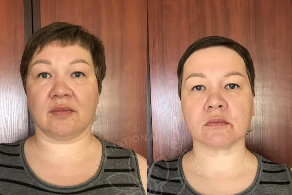 Before and after — less facial puffiness and a slimmer jawline after the 10-day Lymphatic Detox